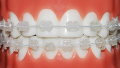 Clear Fixed Ceramic Braces Tunbridge Wells