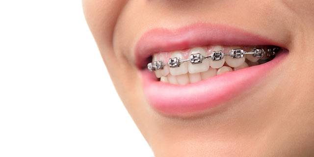 How to Look After Your Braces While Self-Isolating