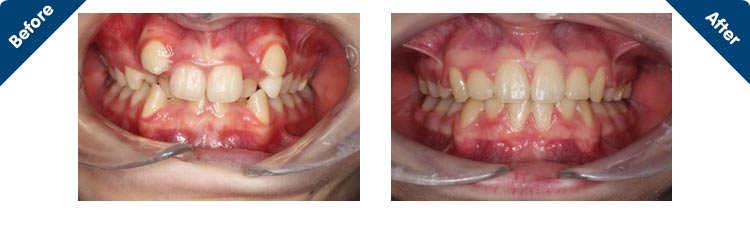 Overbite  Tunbridge Wells Orthodontics